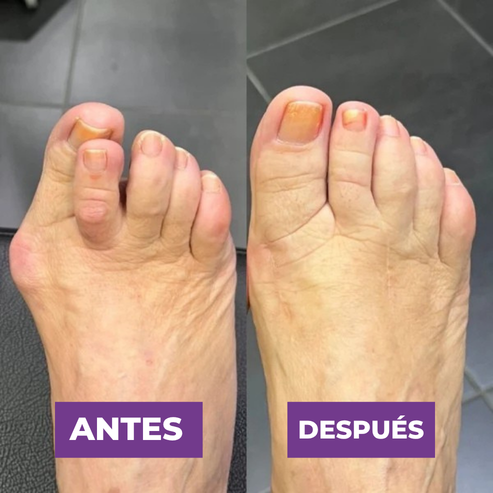 PROMO ANTI BUNION ORTOPEDICO